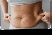 راهکارهای موثر در درمان افتادگی و شل شدن پوست شکم بعد از لاغری و یا رژیم